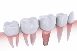 Dental implant example model