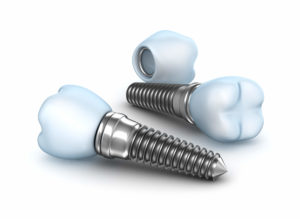 dental implants example model