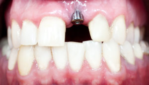 Teeth example model