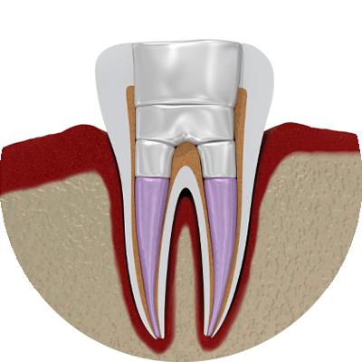 3d model of root canal retreatment