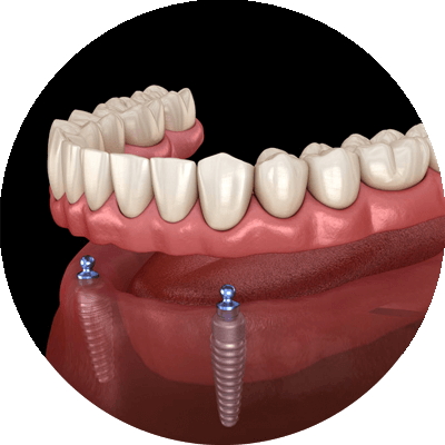 Implant supported denture 3d model
