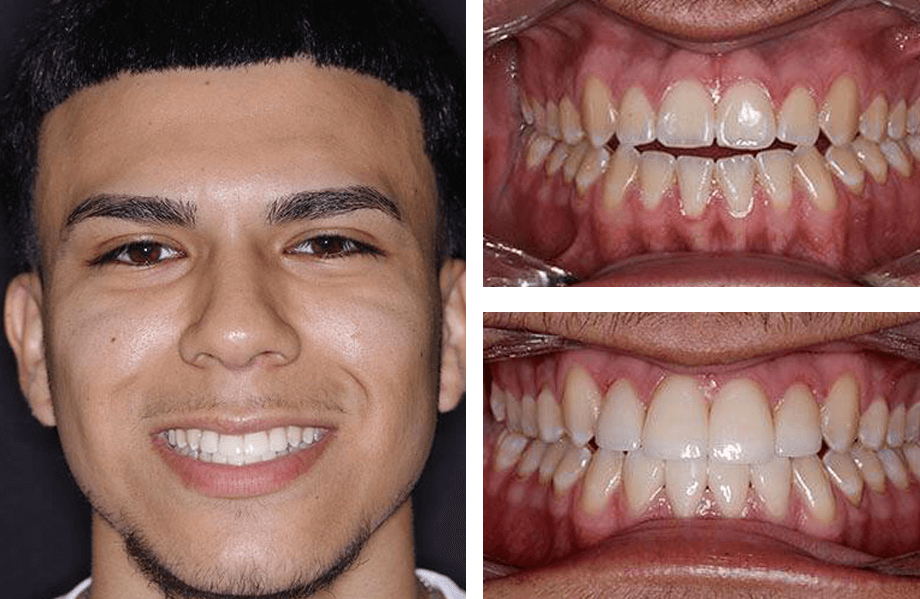 case12 teethwhiteninglengthening beforeafter