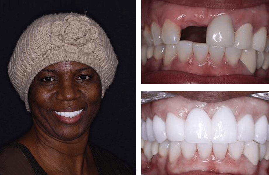 case13 singleimplant beforeafter