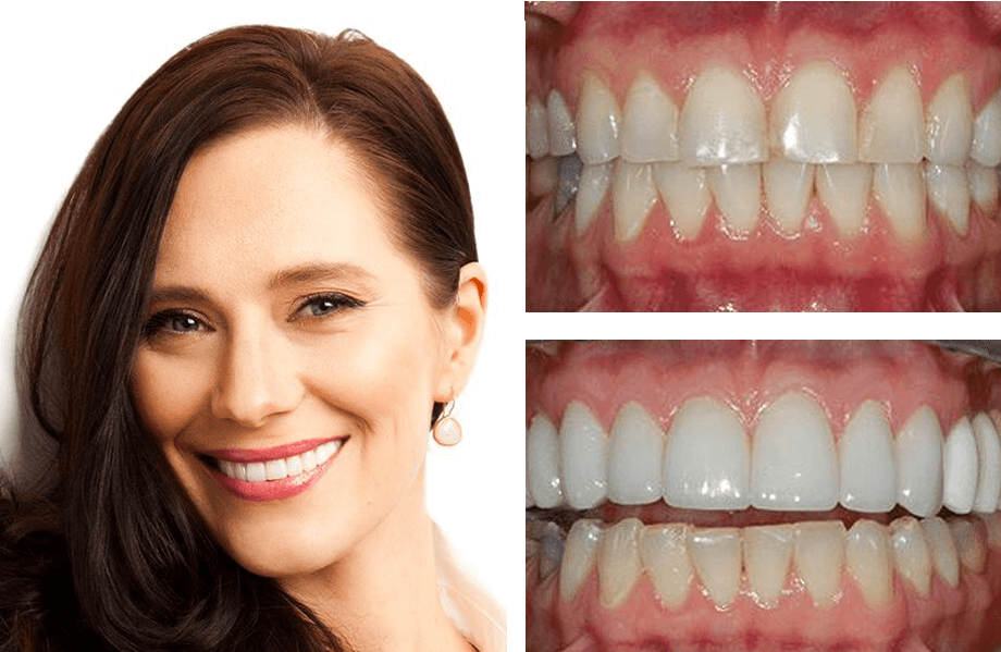 case23 crownlengthwhitening. beforeafter