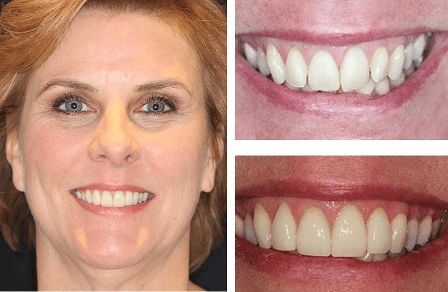 case31 crownlengthwhitening beforeafter