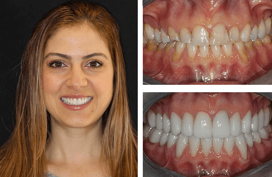 case 34 crownlengthwhitening beforeafter