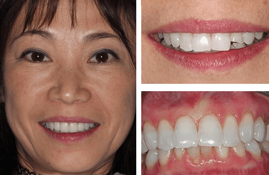 case 39 veneers beforeafter