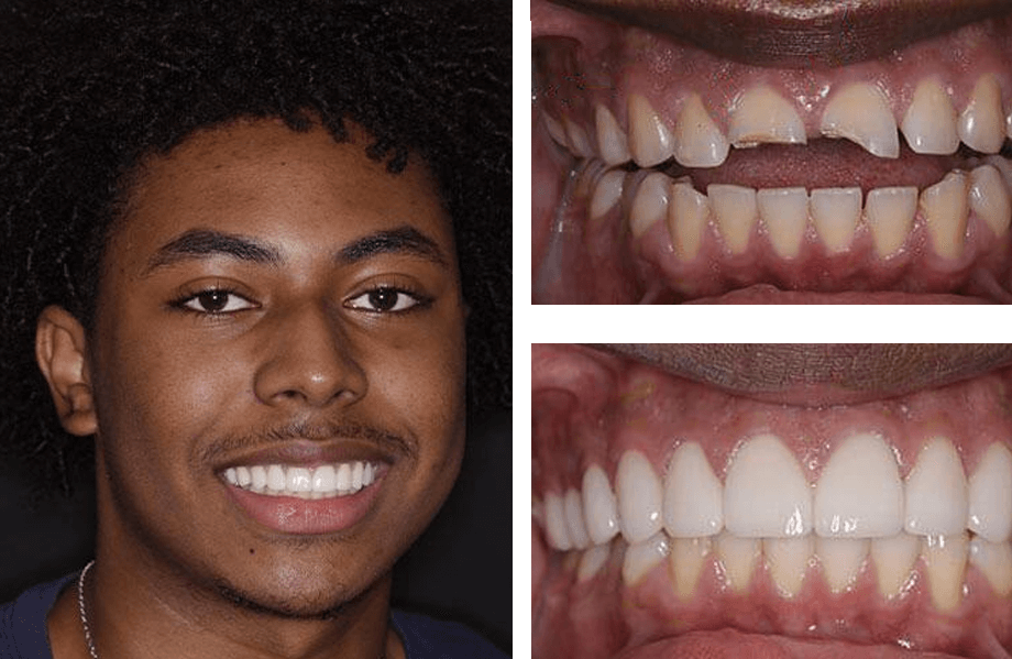 case3 veneers before after