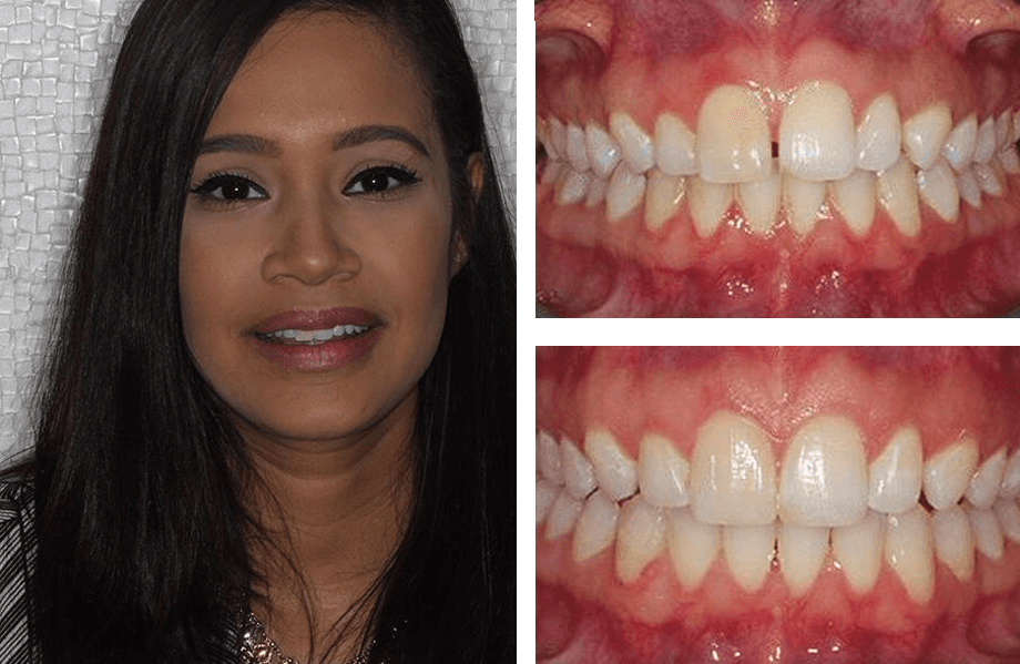 case 41 veneers beforeafter