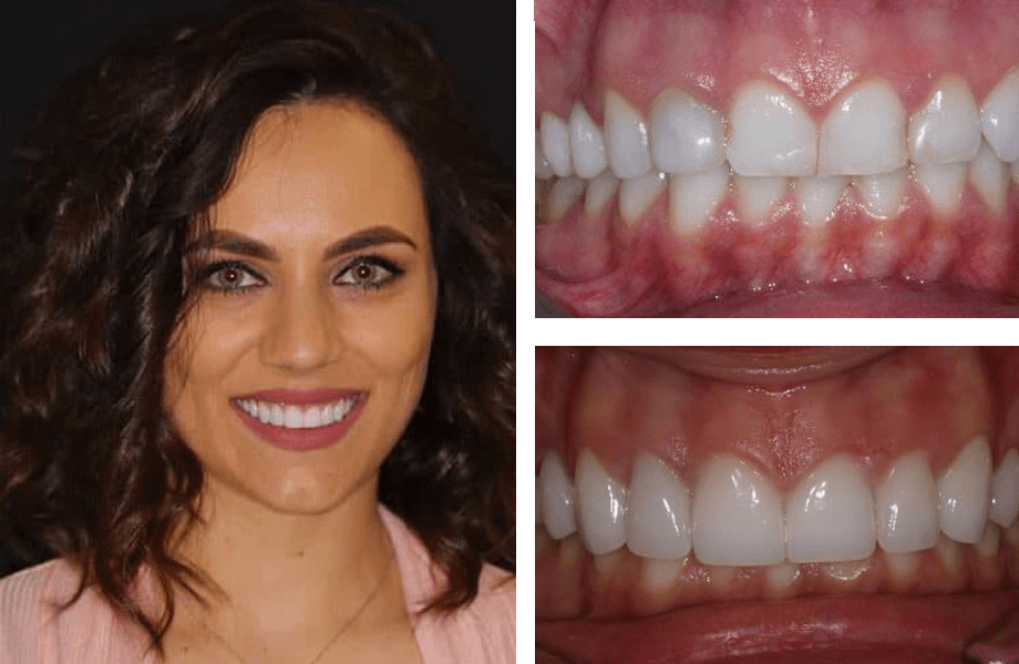 case 46 crownlengthwhitening beforeafter