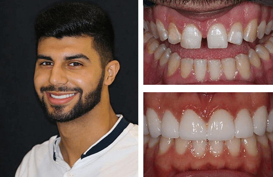 case 49 veneers whitening beforeafter