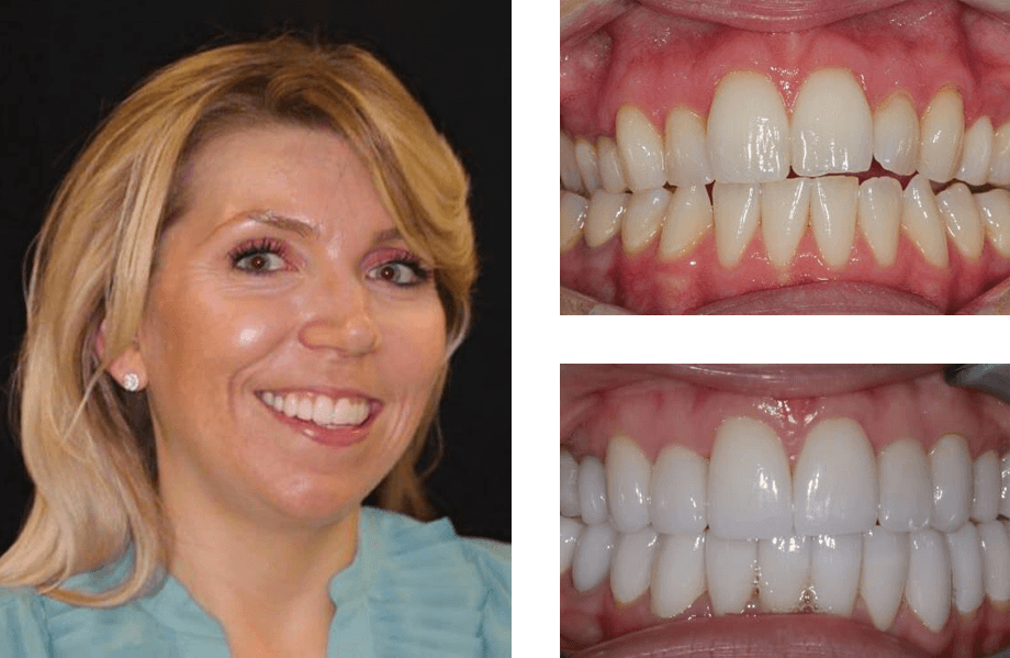 case 50 crownlengthwhitening beforeafter