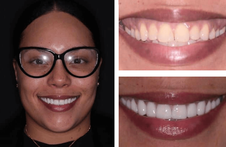 case 72 crownlengthwhitening beforeafter