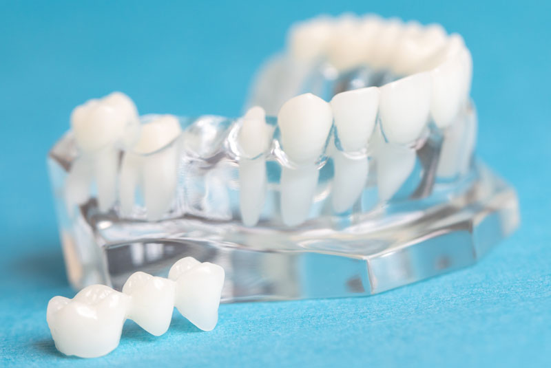 dental crown model on counter top