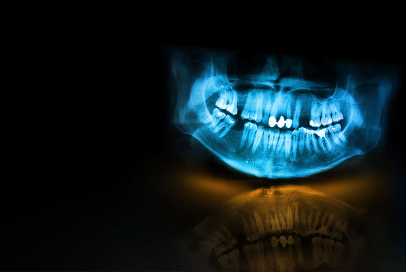 dental xray of dental patients mouth with missing teeth