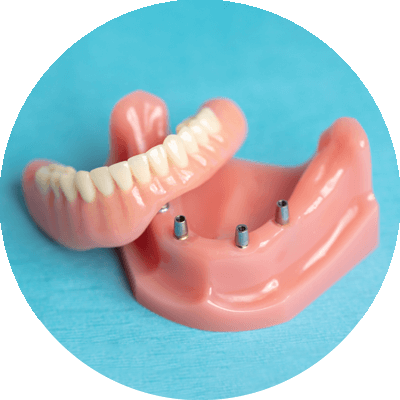 implant supported dentures on table