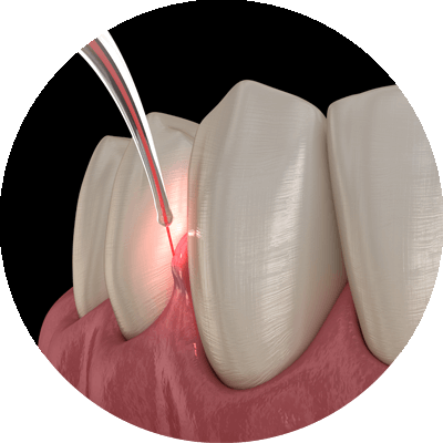 lanap laser being used_ongums dental procedure