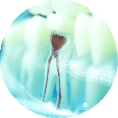 root canal model