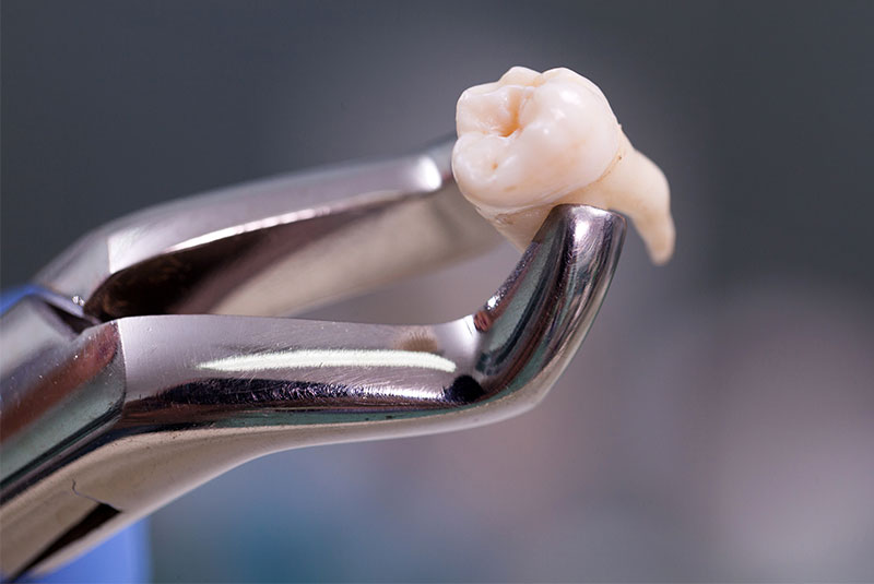 tooth extraction