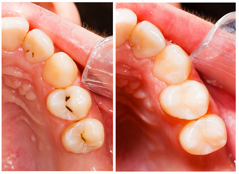 Tooth Filling Options