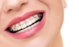 Woman smiling with braces