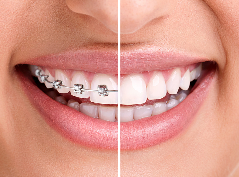 Braces before & after
