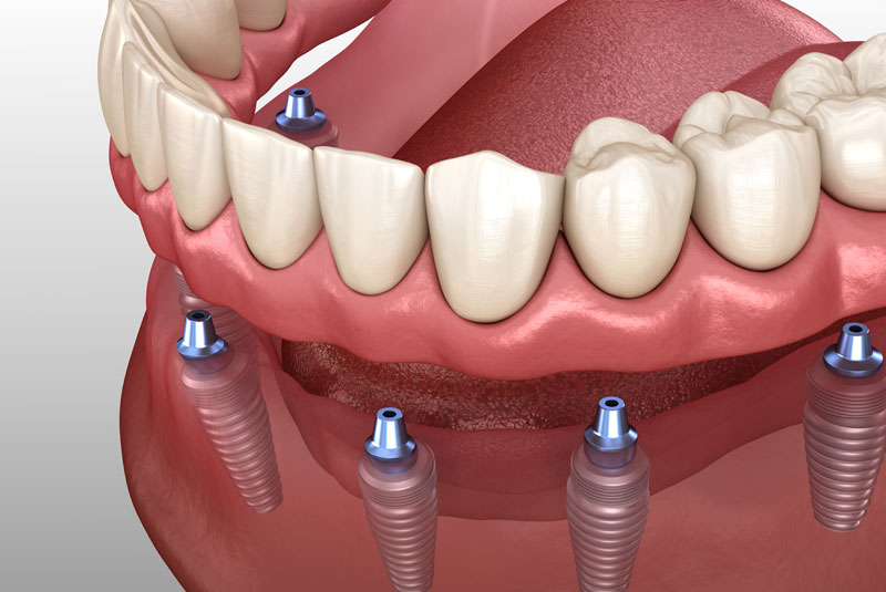 a digital model of a lower arch after an implant supported denture procedure.
