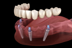 a side profile of a full mouth dental implant model. with full mouth dental implants, four dental implant posts are secured in the jawbone to hold a prosthesis in place.
