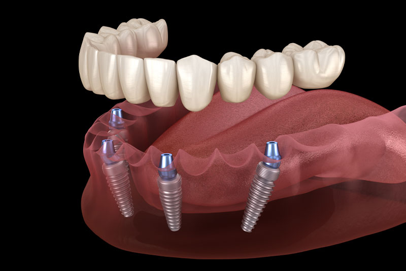 a side profile of a full mouth dental implant model. with full mouth dental implants, four dental implant posts are secured in the jawbone to hold a prosthesis in place.